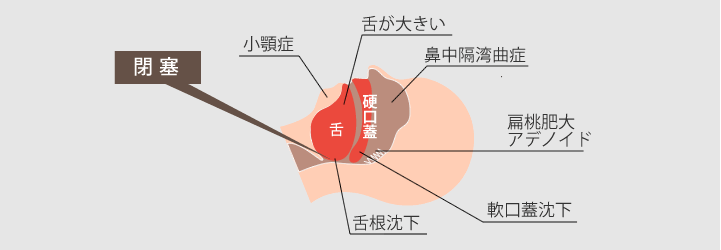 SASの原因