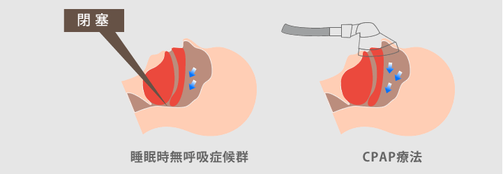 CPAP療法
